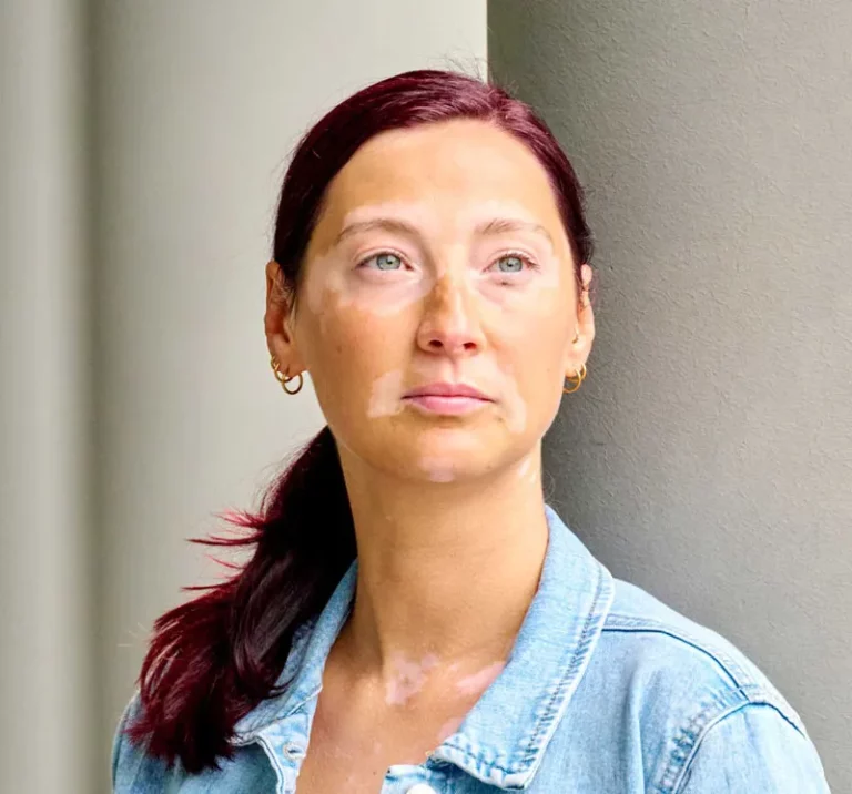 Frau mit Vitiligo Weissfleckenkrankheit im Gesicht blickt in die Ferne