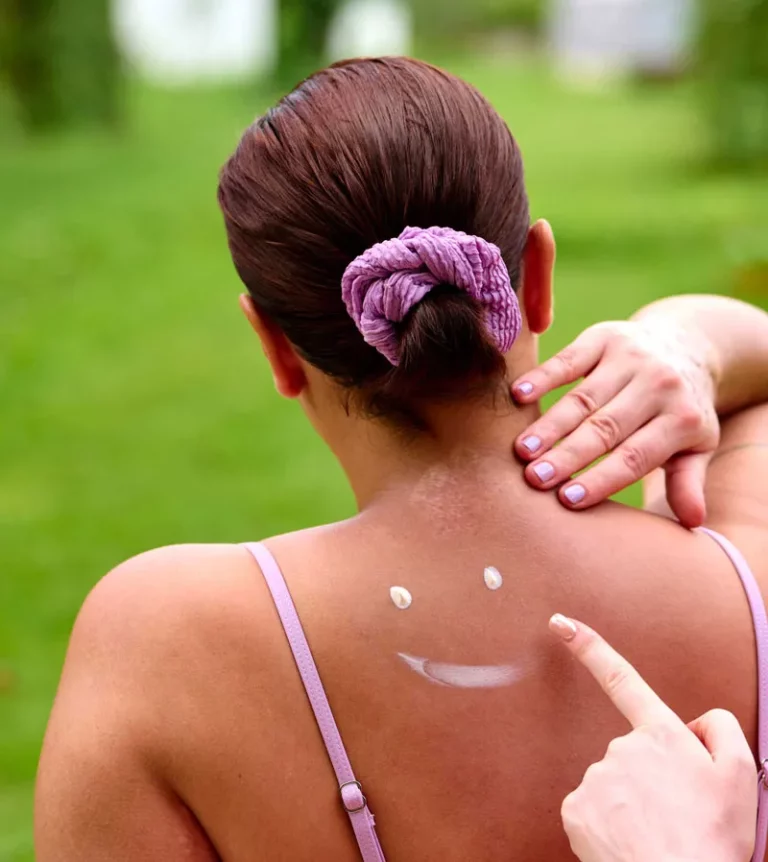 Frau mit Vitiligo hat ein mit Sonnencreme gezeichnetes Smile auf ihren Rücken