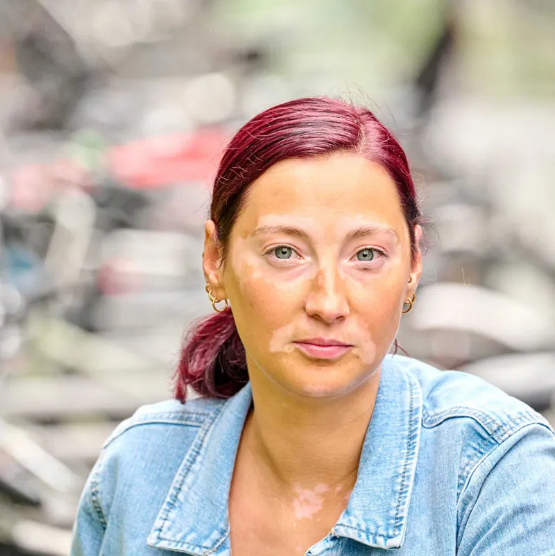 Frau mit Vitiligo Weissfleckenkrankheit im Gesicht, heller Hauttyp mit dunklen Haaren.