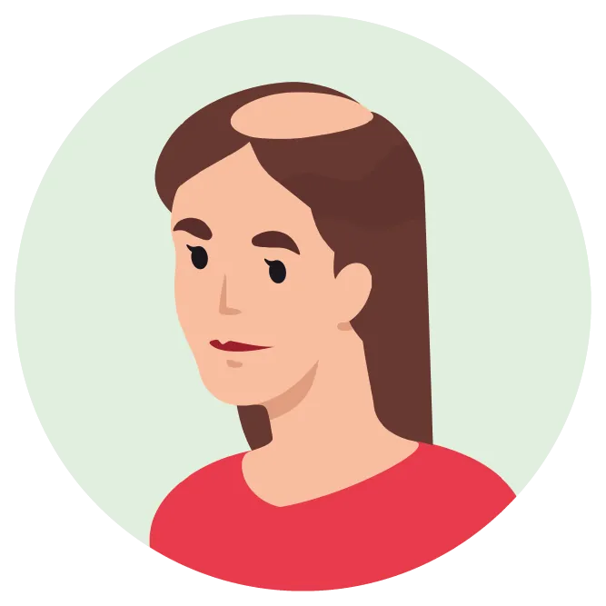 Illustration einer Frau mit kreisrundem Haarausfall (Alopecia areata), als mögliche Autoimmun-Erkrankung im Zusammenhang mit einer nichtsegmentalen Vitiligo.