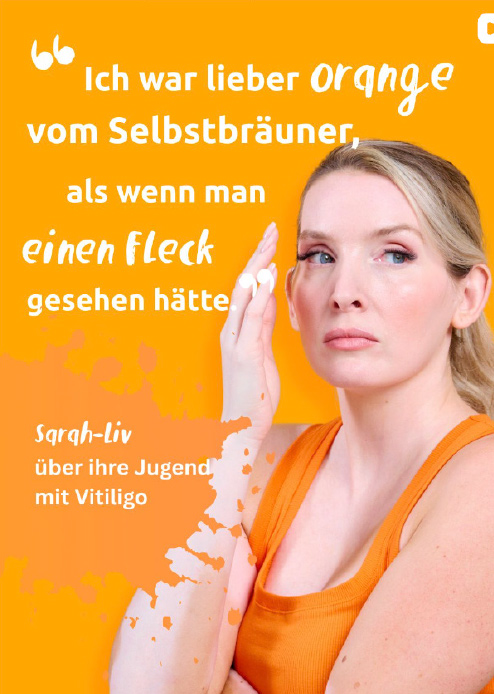 Post von @uncovervitiligo, dem Instagram-Kanal für Menschen mit Vitiligo, über eine Frau und ihren Versuch, ihre hellen Flecken mit Selbstbräuner zu verstecken