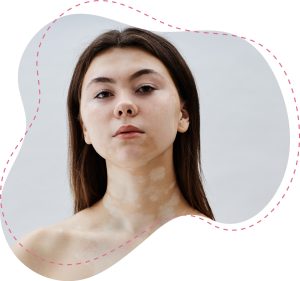 Gesicht von Frau mit Vitiligo bzw. hellen Flecken, die den Betrachter anschaut