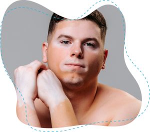 Gesicht von Mann mit Vitiligo bzw. hellen Flecken, der den Betrachter anschaut