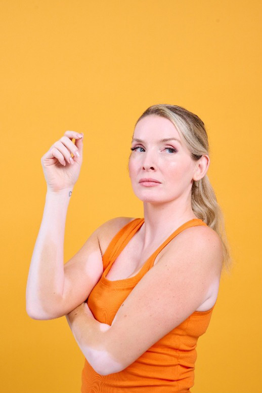 Frau mit angewinkeltem Arm und sichtbarer Vitiligo an beiden Armen