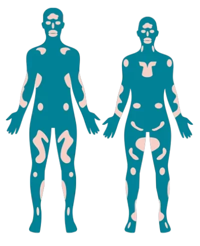 llustration der Flecken bei nichtsegmentaler Vitiligo Illustration von zwei Menschen mit nicht-segmentaler Vitiligo. Die Flecken breiten sich spiegelgleich auf beiden Körperseiten gleichermaßen aus.